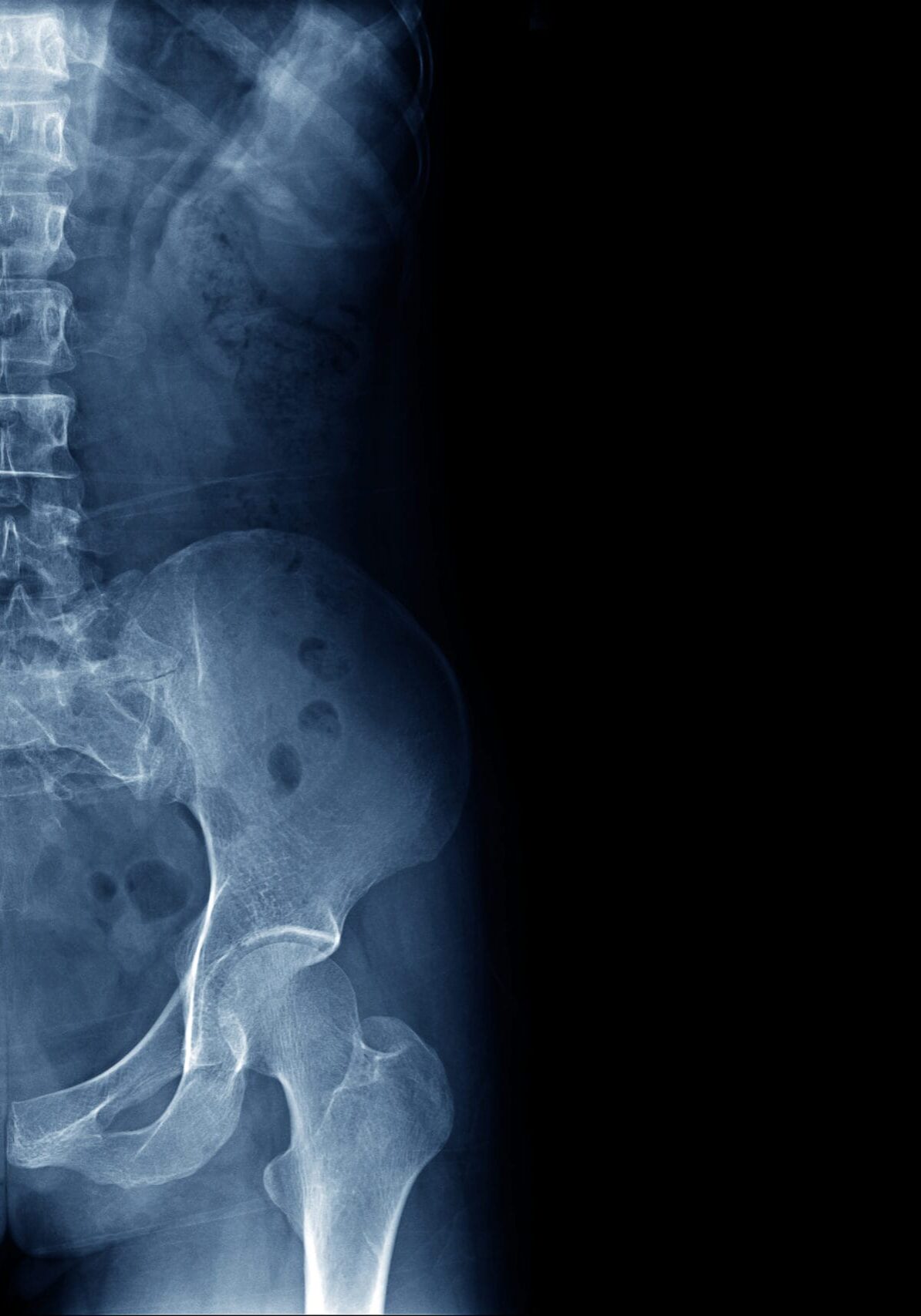 x-ray image of human normal spine, rips, pelvis, both hip joint and blank area at right side